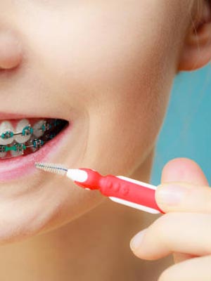 Interdental Cleaning